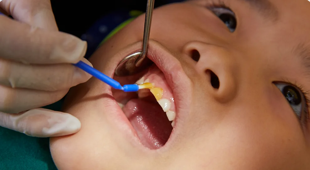 혼합치열기 어린이 치아교정과 소아교정 시기