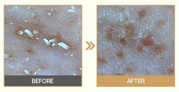 Improvement of skin texture ; Papa Recipe Pack & Foam