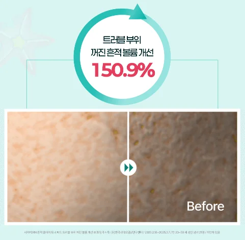 [시카 pdrn 토너 패드 전후] 트러블 부위 꺼진 흔적