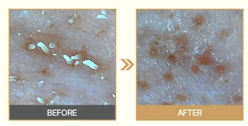 Cleaning the skin waste