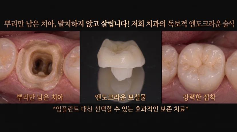 뿌리만 남은 치아의 엔도크라운 치료 전후 비교 - 발치 전 잔존치근, 세라믹 엔도크라운 보철물, 접착 완료 후 모습을 단계별로 보여주는 임상 사진