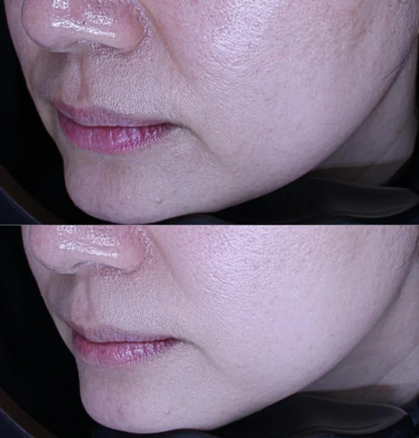 Before and After Xerf 600 shots in 40s