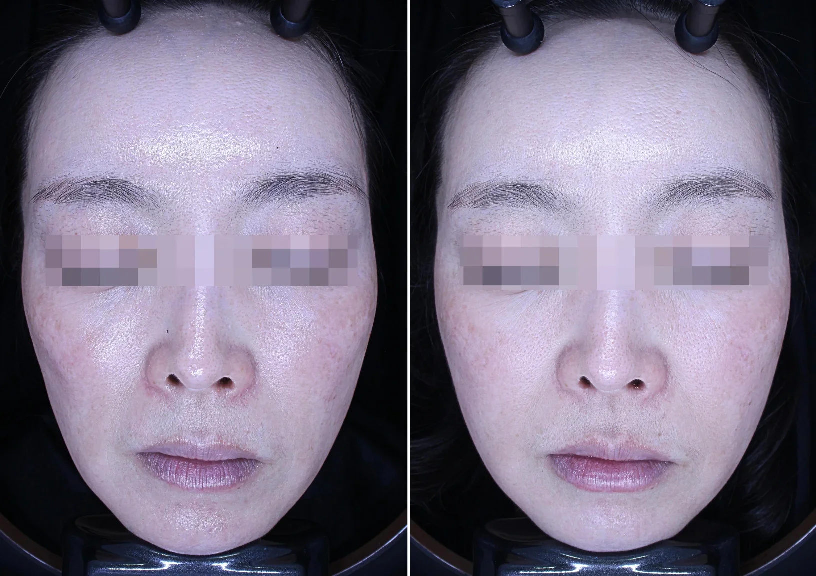 Before and After Juvelook Volume Treatment