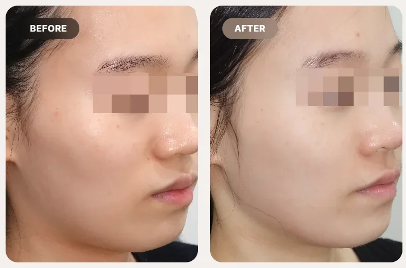 Before and After Juvelook Volume Treatment