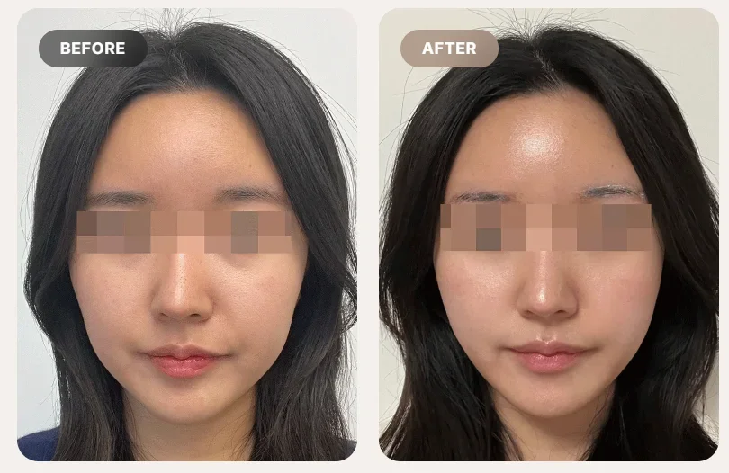 Before and After Ultherapy 600 shots treatment