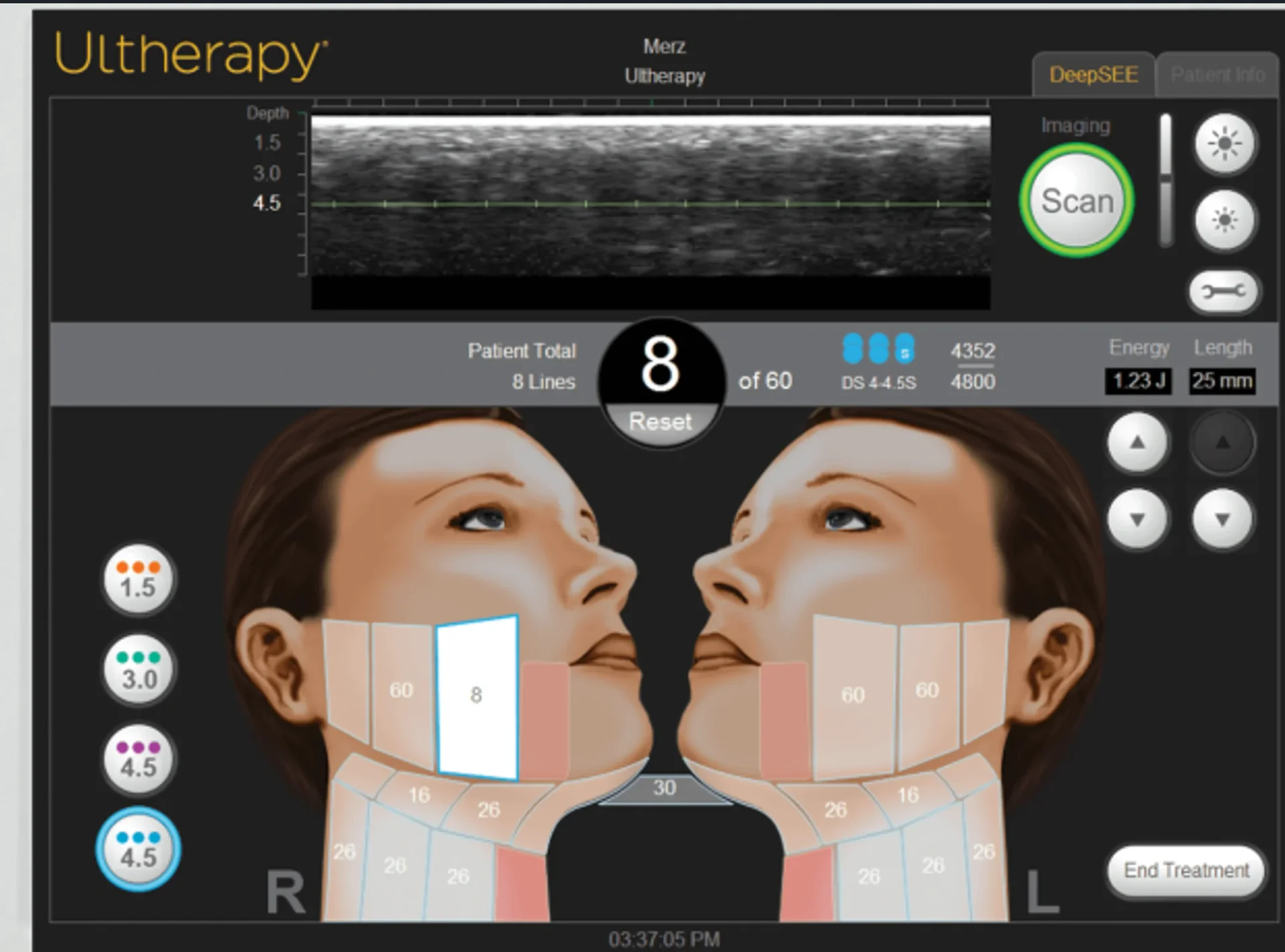 Ultherapy Device Screen