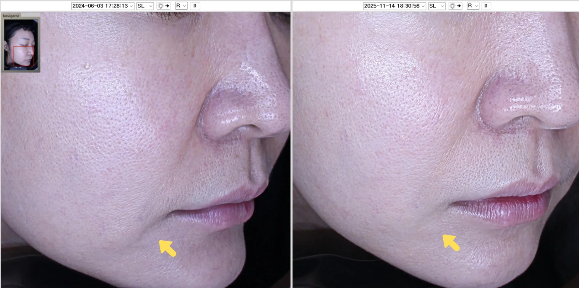 Before and After Jowl Reduction