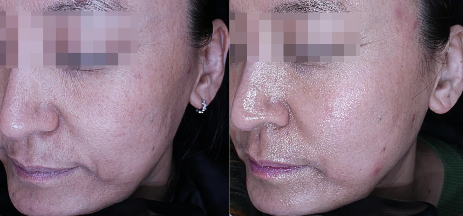 Before and After Thermage 600 shots Treatment