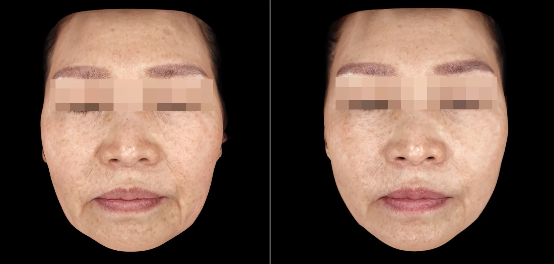 Before and After Ultherapy 400 Shots Treatment
