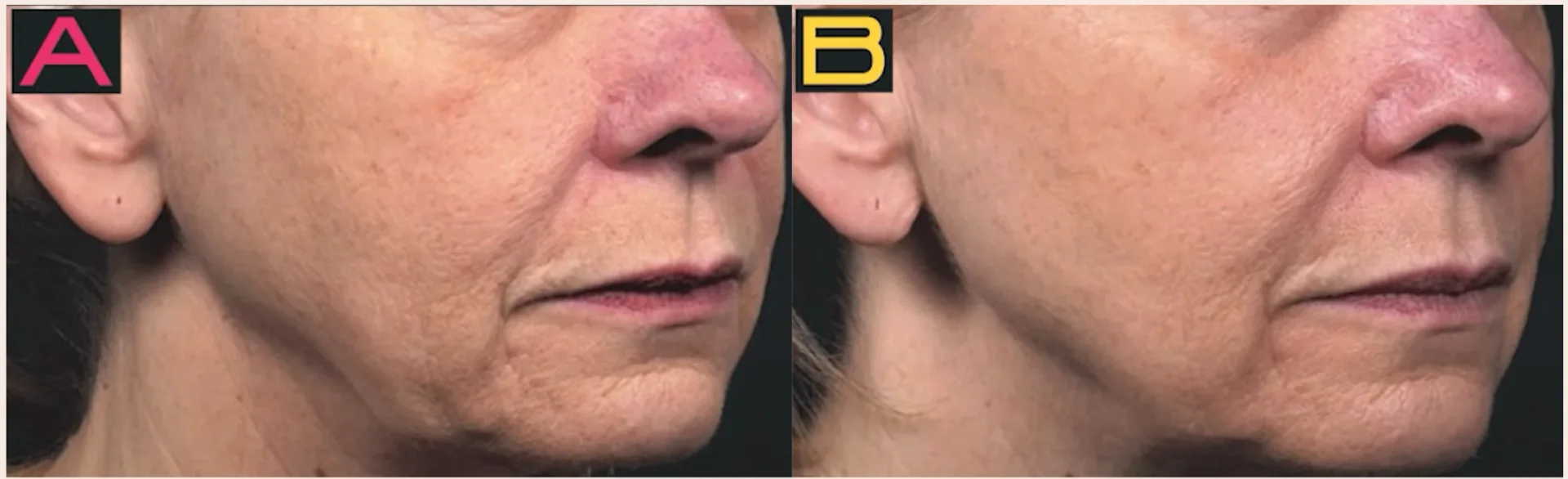 Before and After High-Frequency Tightening Procedure