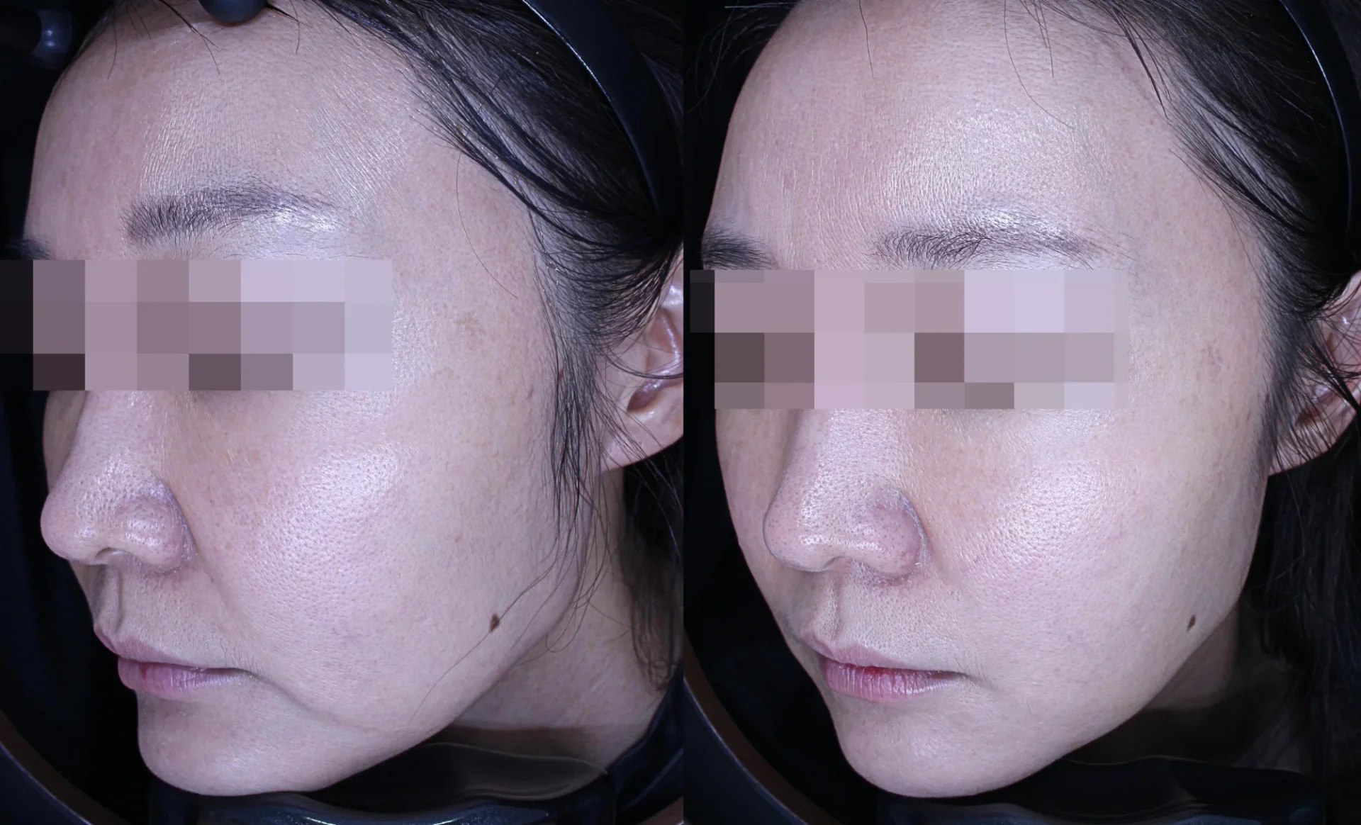 Before and After Xerf Treatment