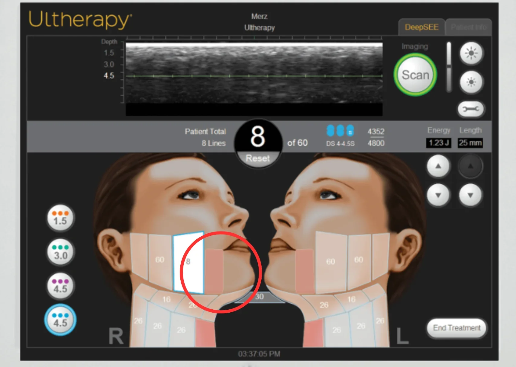 Limitations of Ultherapy - Jowls