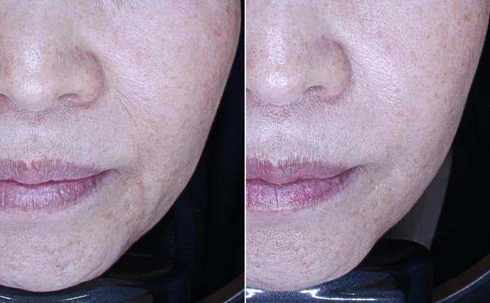 Before & After Radiesse for Nasolabial Folds and Perioral Lines