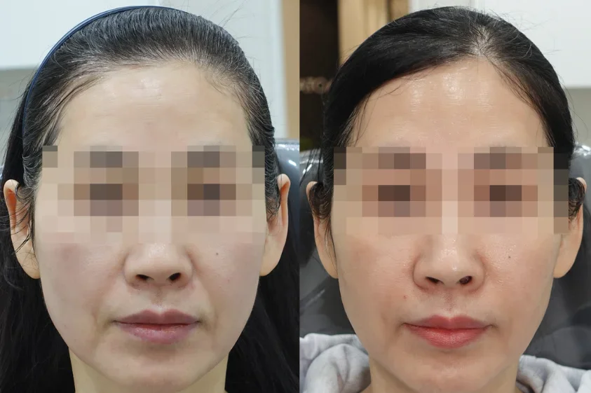 Before and After 2 Sessions if Radiesse Treatments for Nasolabial Folds