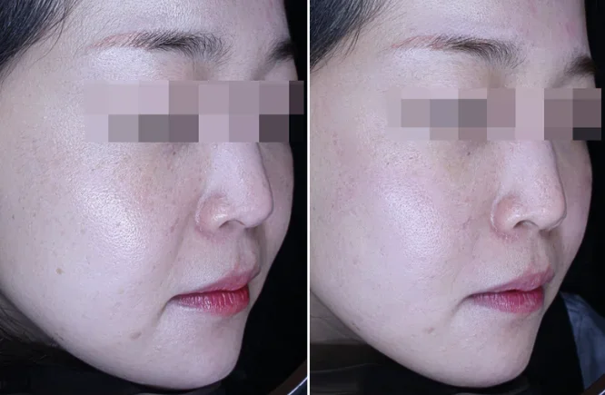 Before and After Emface Treatment