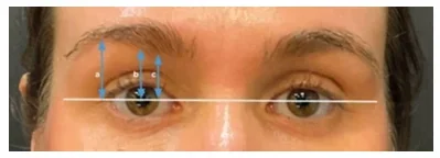 Emface Eyebrow Lifting Effect