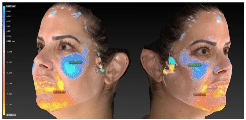 Emface Midface Lifting