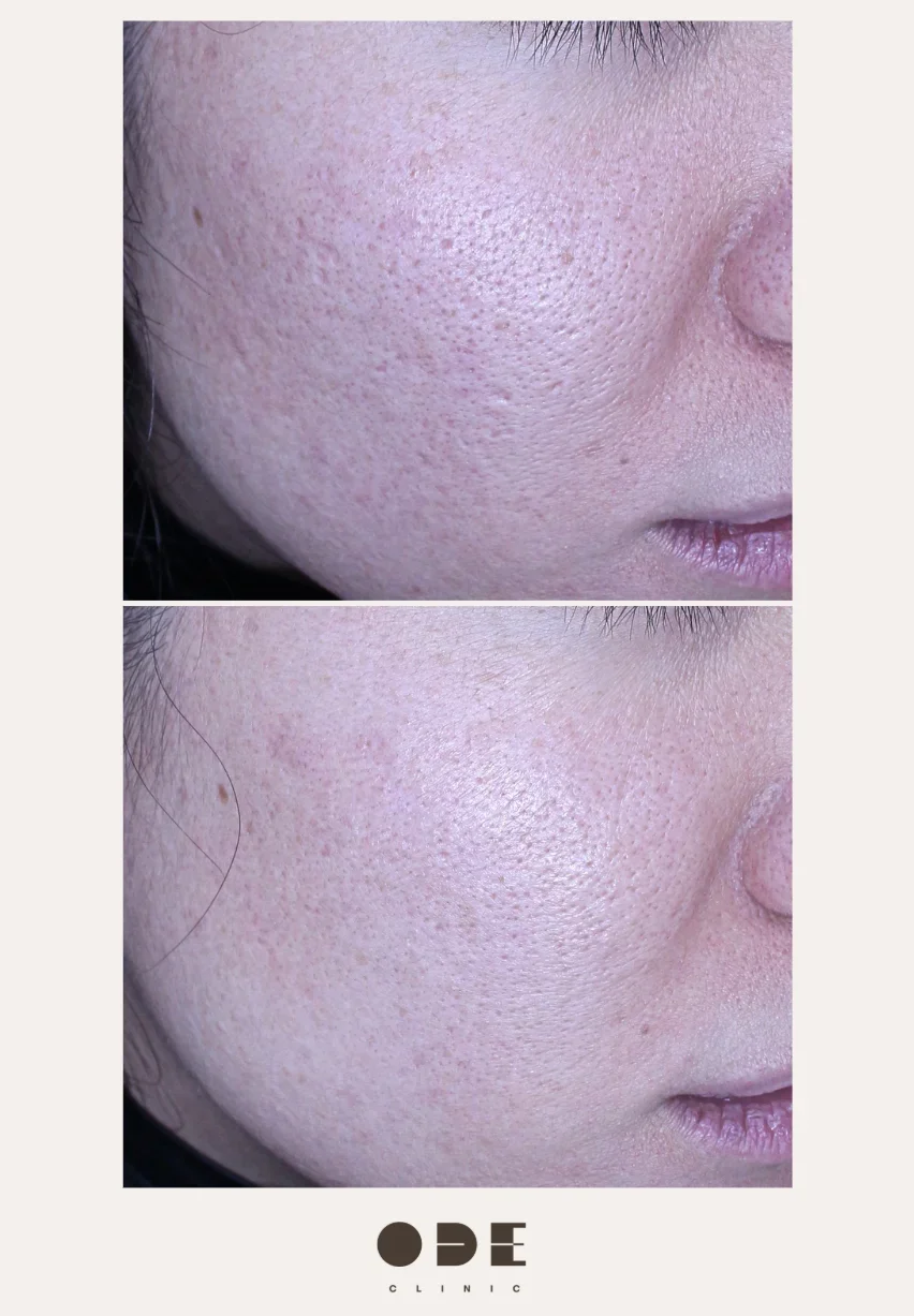 Before and After Juvelook Skin Booster Treatment
