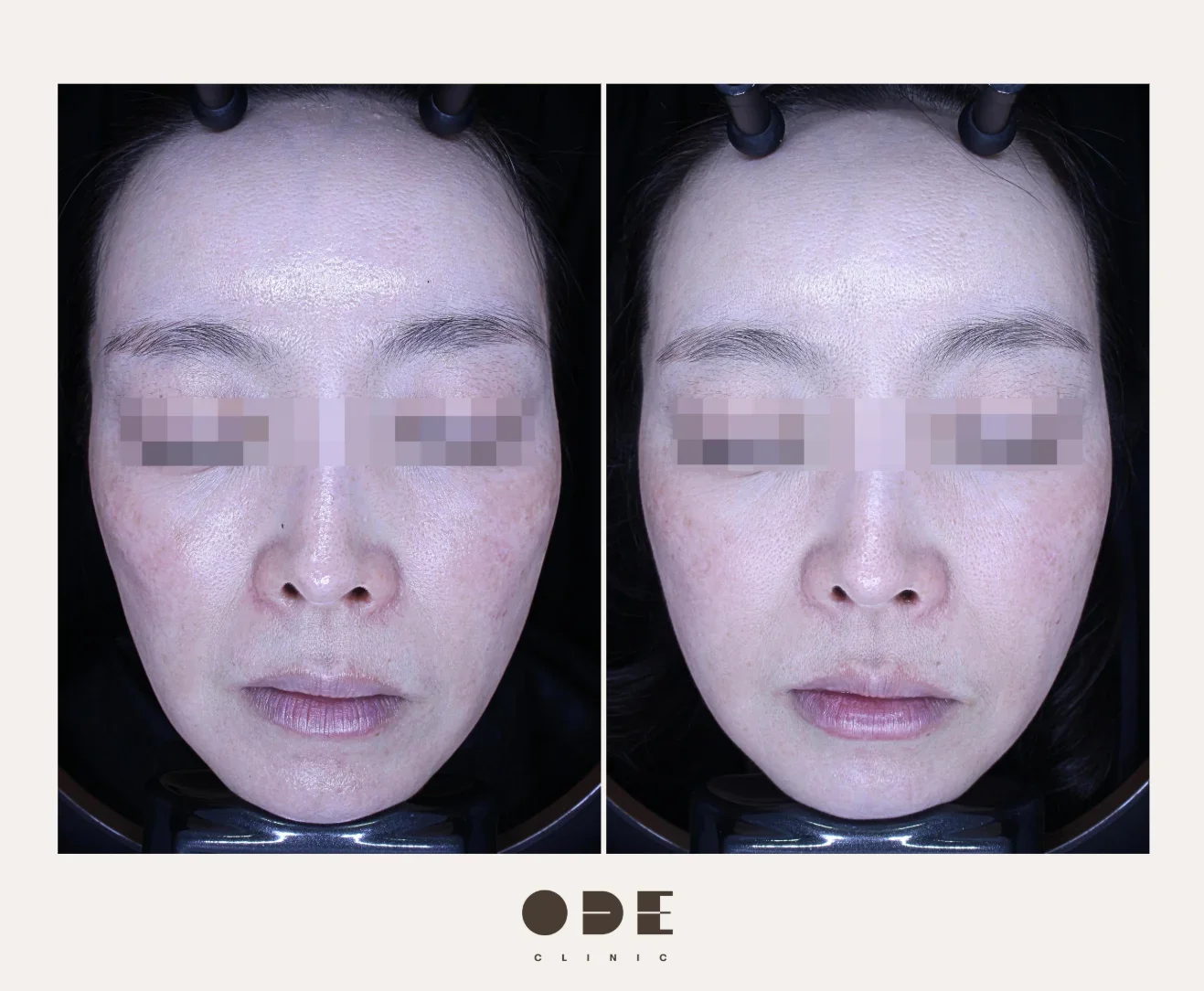 Before and After Juvelook Volume Treatment