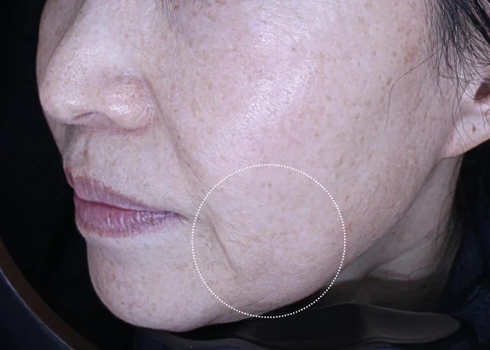 Jowls and Marionette Lines