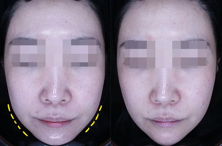 Before and After Ultherapy Treatment