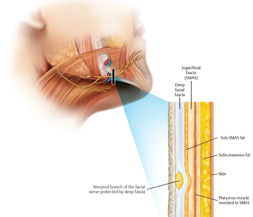 Course of the marginal mandibular nerve