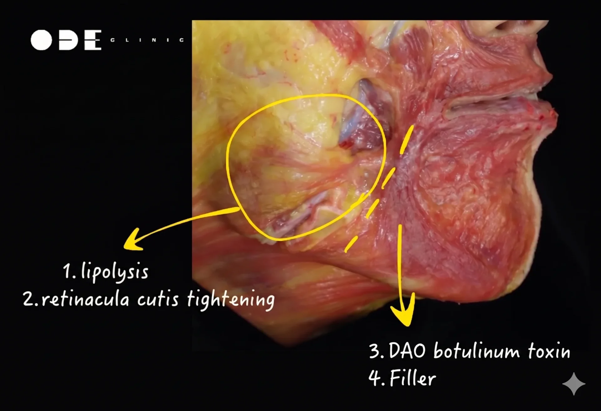 Strategies for Jowl Reductions: An Anatomical Perspective