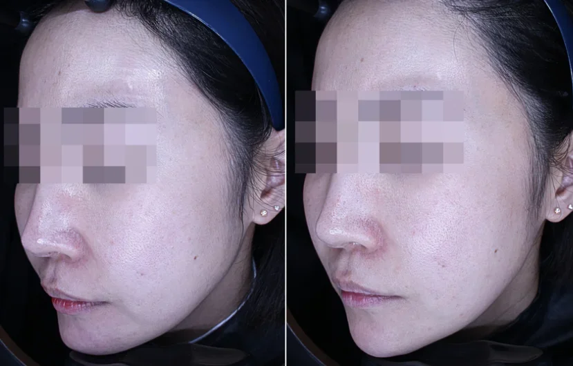 Before Treatments / 2 Weeks After Ultherapy, Xerf Treatments