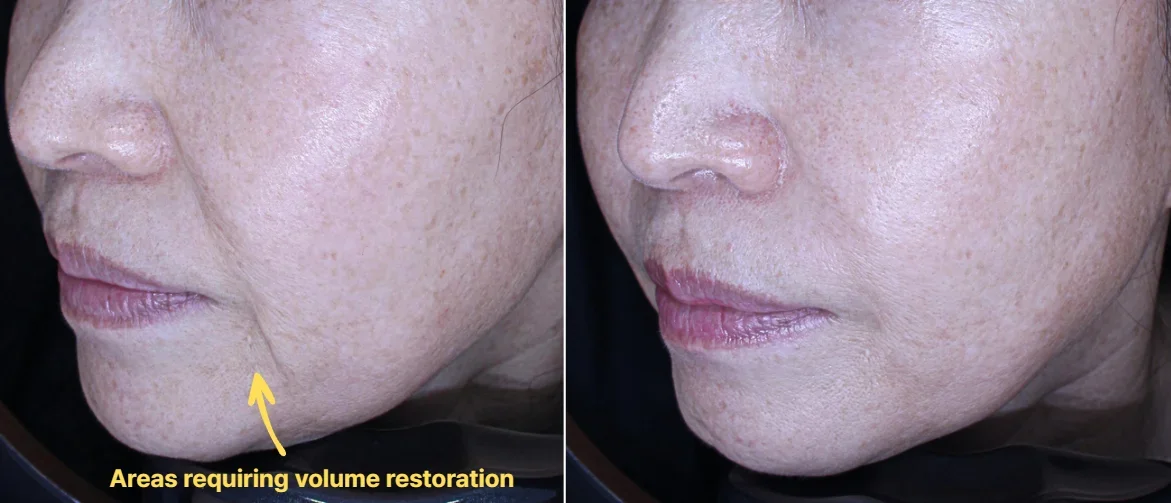 Filler Injection Sites for Marionette Lines