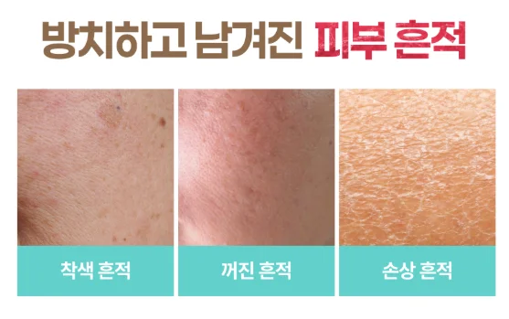 민감성 피부 트러블 흔적 3가지 정리 이미지