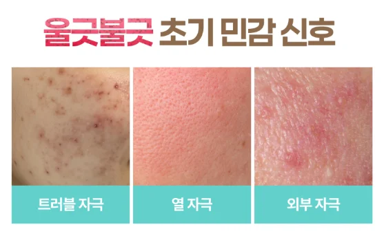 민감성 피부 유형별 이미지 - 트러블,열,외부 자극