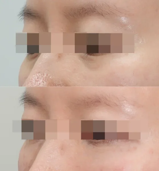 Before and After Restylane Eyelight for Under-Eye 