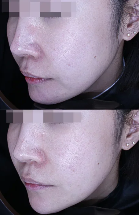 Before and After Xerf 300 Shots