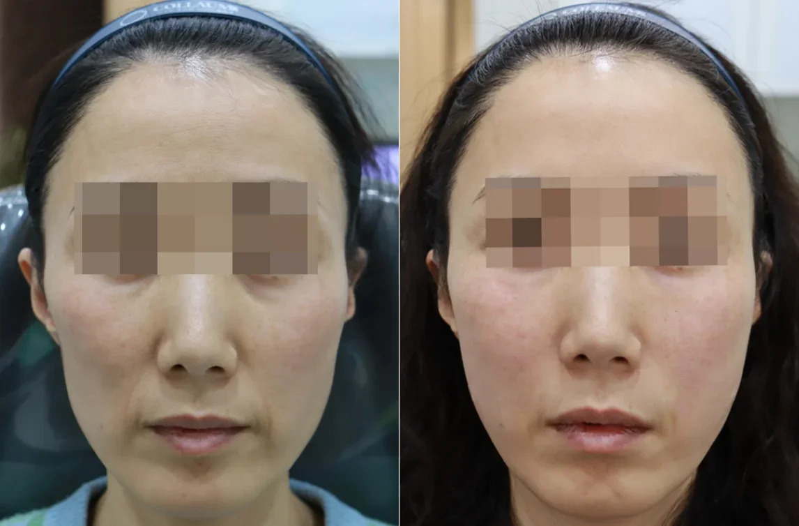 Before and After Sculptra Treatment