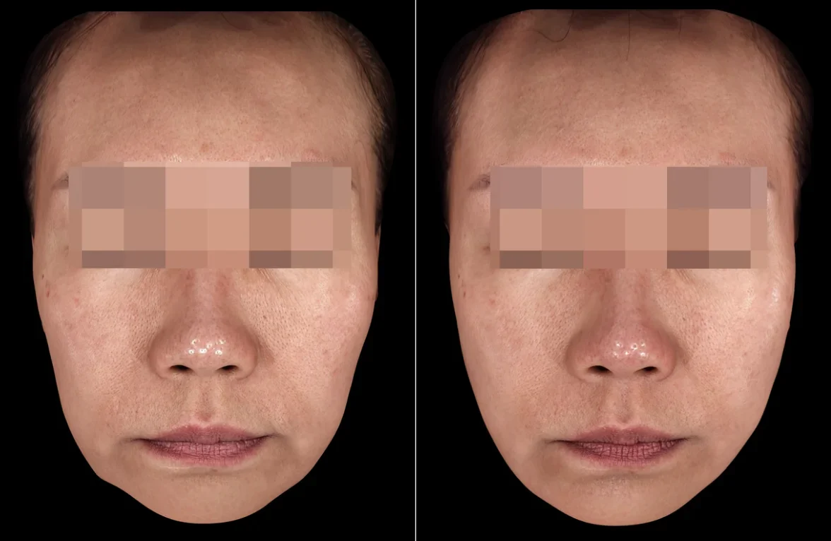 Before and After Sculptra Treatment
