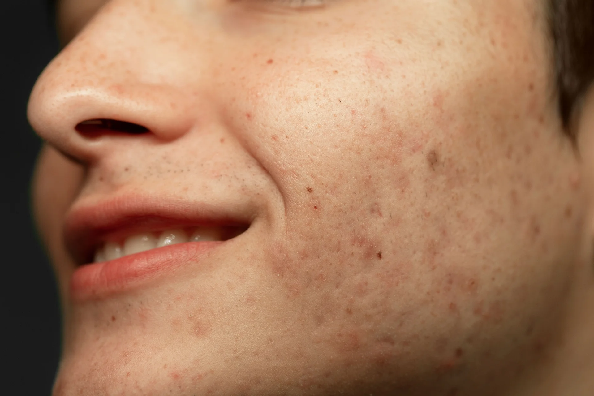 sensitive skin after using AHA and Scrubs