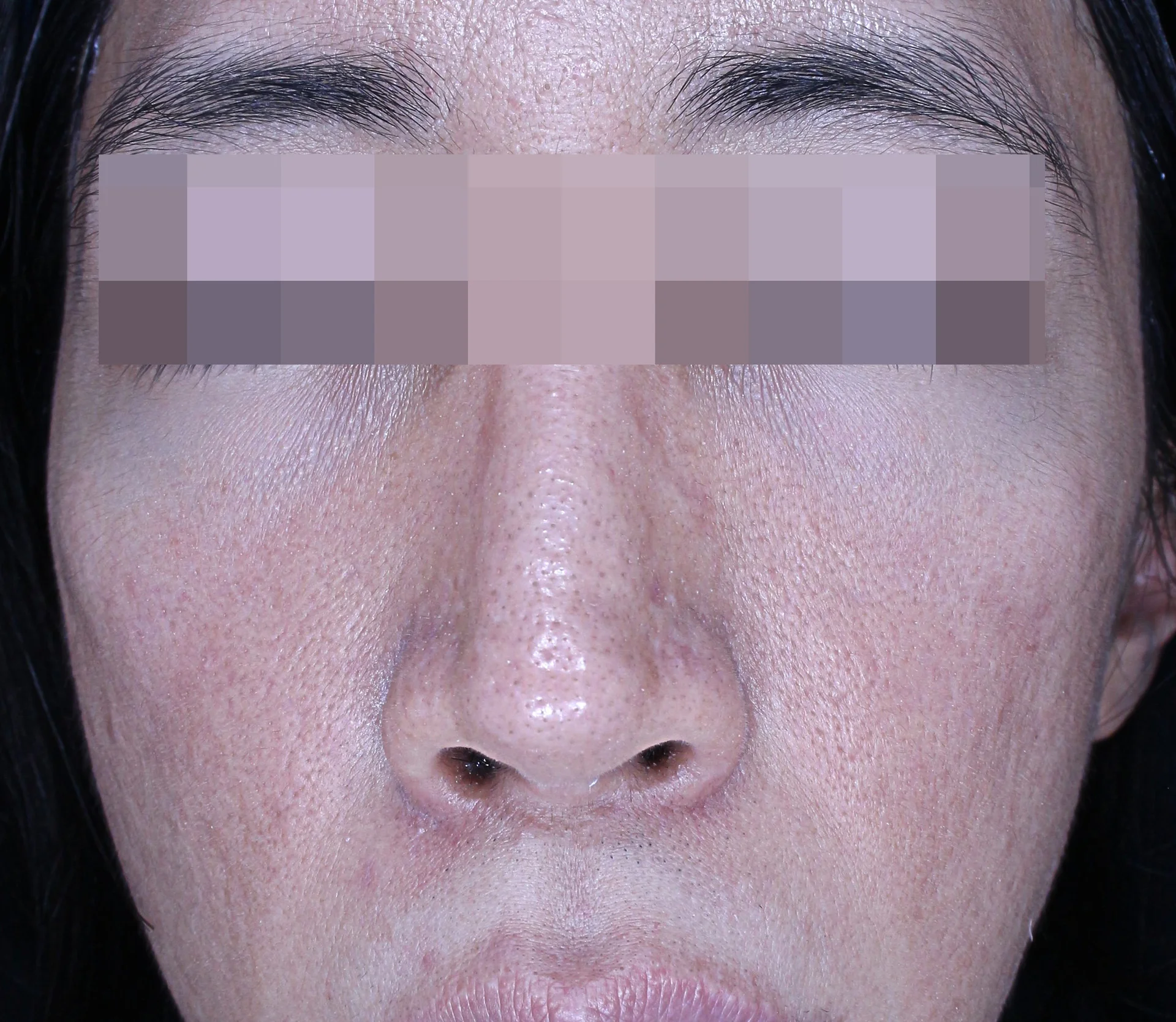 Before and After 3 Sessions of Re2O Treatments