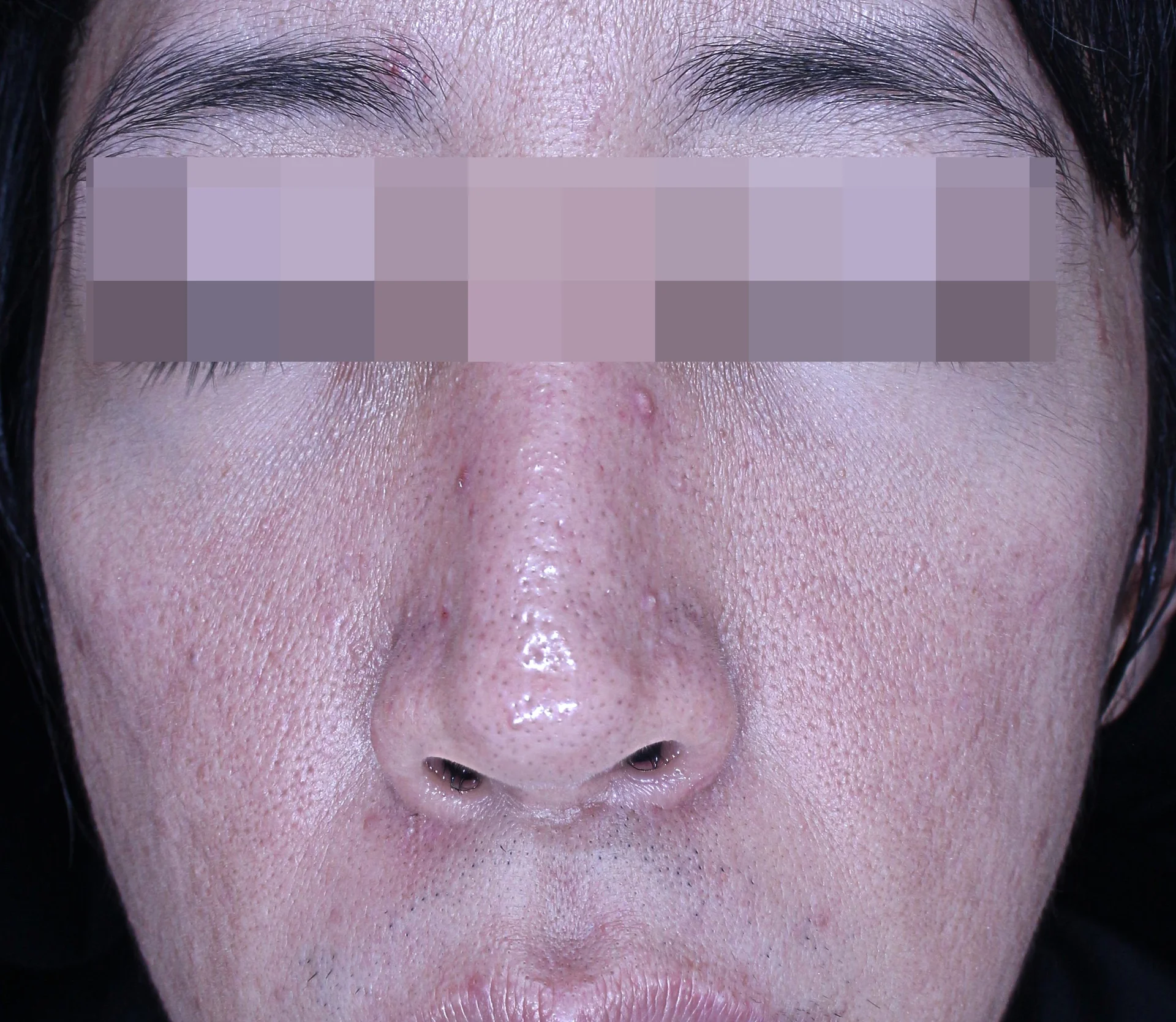 Before and After 3 Sessions of Re2O Treatments