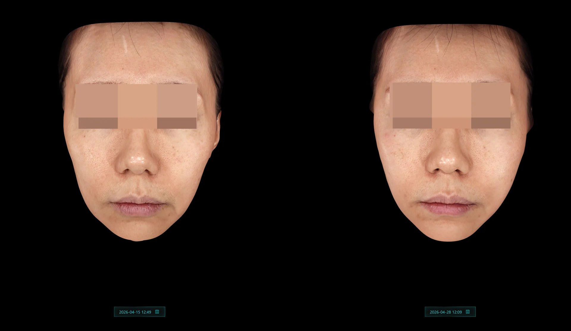 Before and After Hilowave Treatments