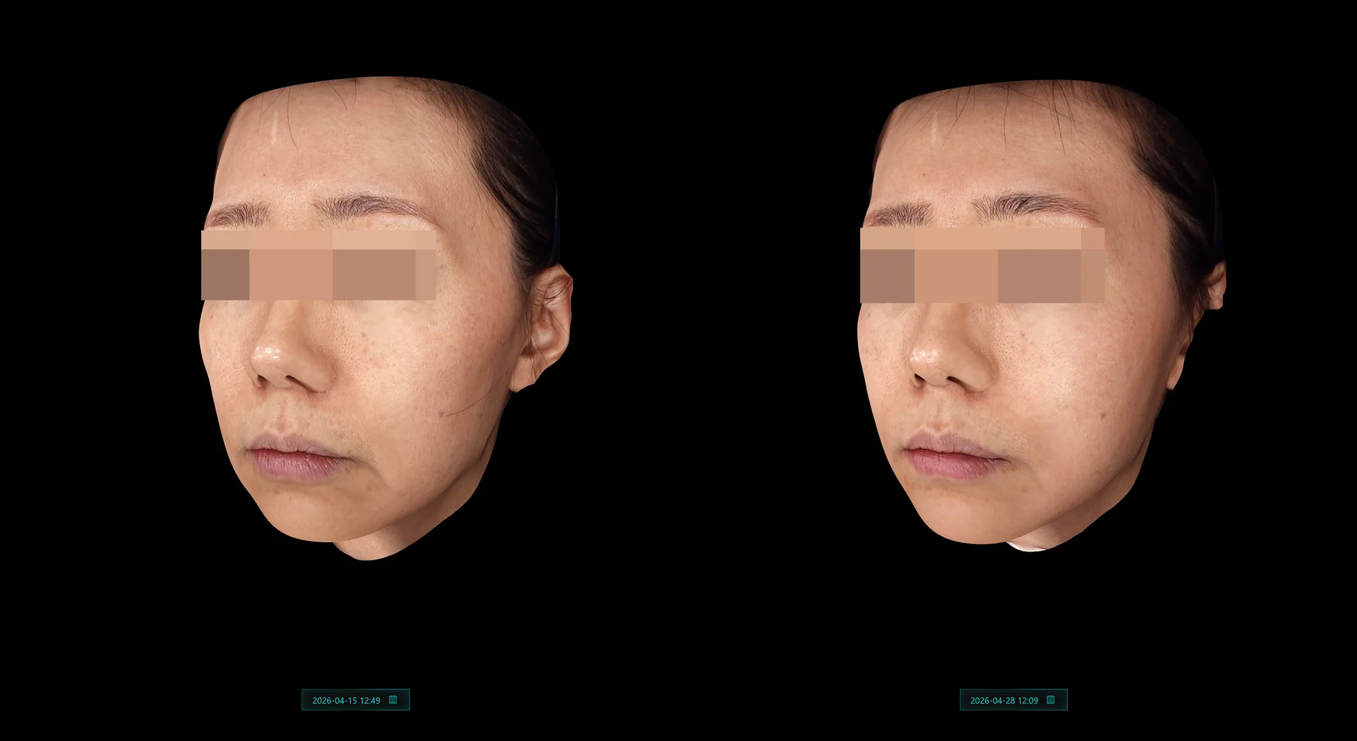 Before and After Hilowave Treatments