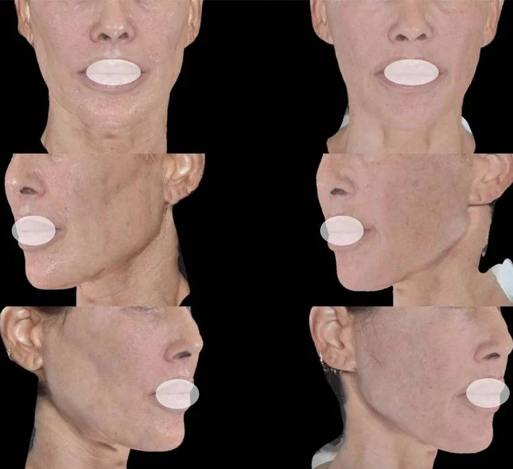 A 53-Year-Old Woman, 2 Years After PLLA Treatment