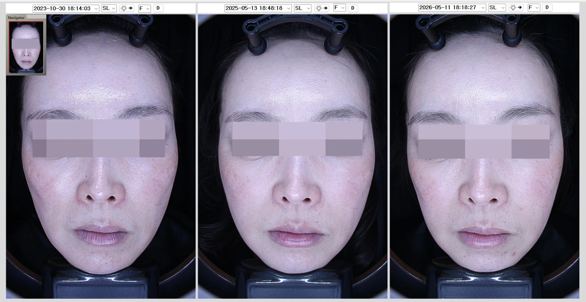 2.5 Years After 3 Sessions of Juvelook Volume Treatment