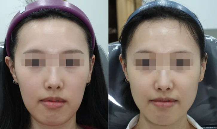 1.5 Years After 3 Sessions of Juvelook Volume Treatment