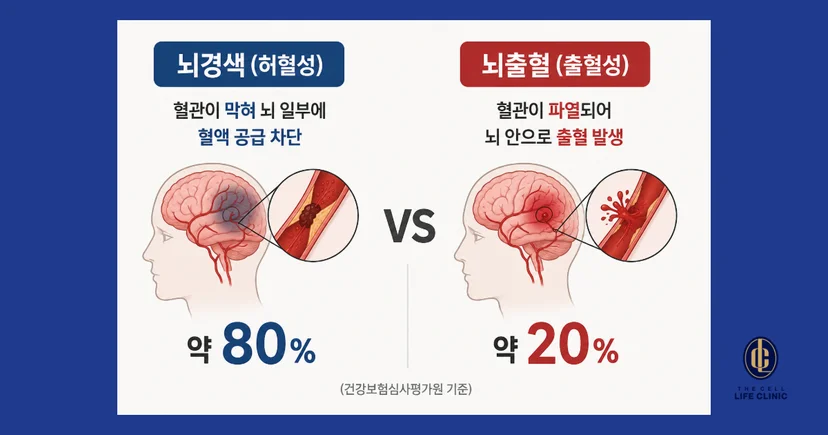 뇌경색과 뇌출혈 비교