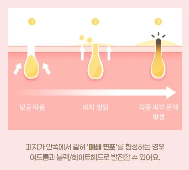 모공 막힘 현상으로 일어날 수 있는 피부 문제를 정리한 이미지