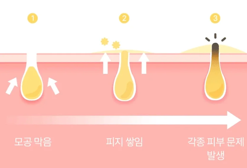 지성 피부 블랙헤드가 만들어지는 과정을 설명한 이미지