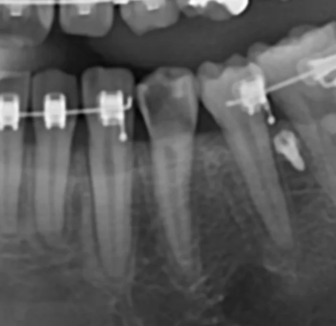 성신여대-성북구-심한충치-어금니-파노라마-Xray-발치임플란트진단-엔도크라운전-성모치과의원