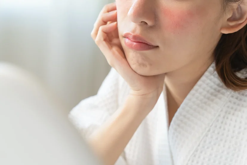 세안 후 얼굴이 당겨 붉어진 수부지 피부