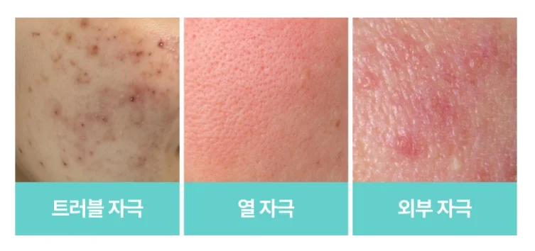 민감성 여드름 피부 관리 전 
