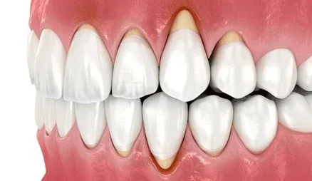 내려간 잇몸, gingival recession